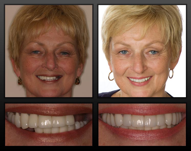 tooth transplant